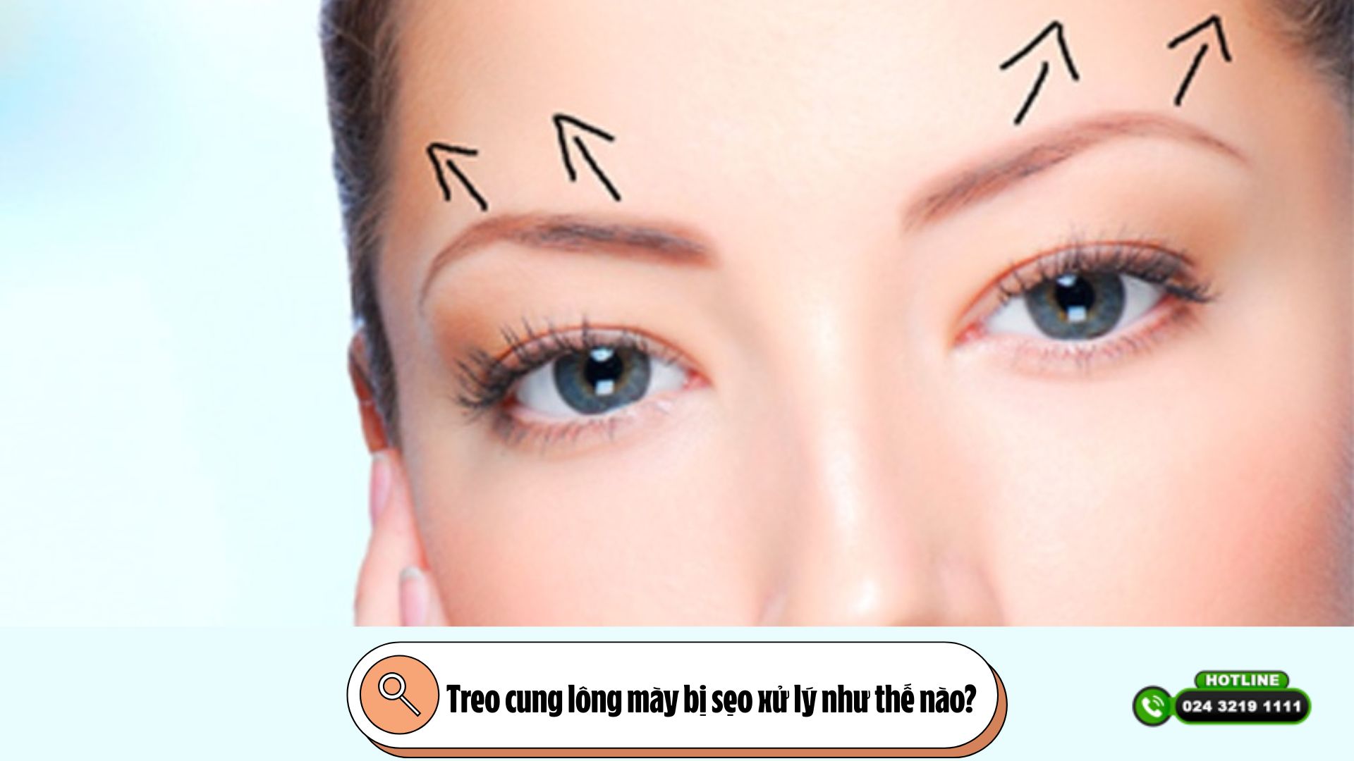 Treo cung lông mày bị sẹo xử lý như thế nào?