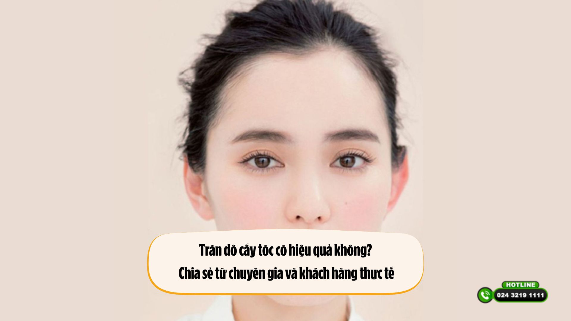 Trán dô cấy tóc có hiệu quả không? Chia sẻ từ chuyên gia và khách hàng thực tế