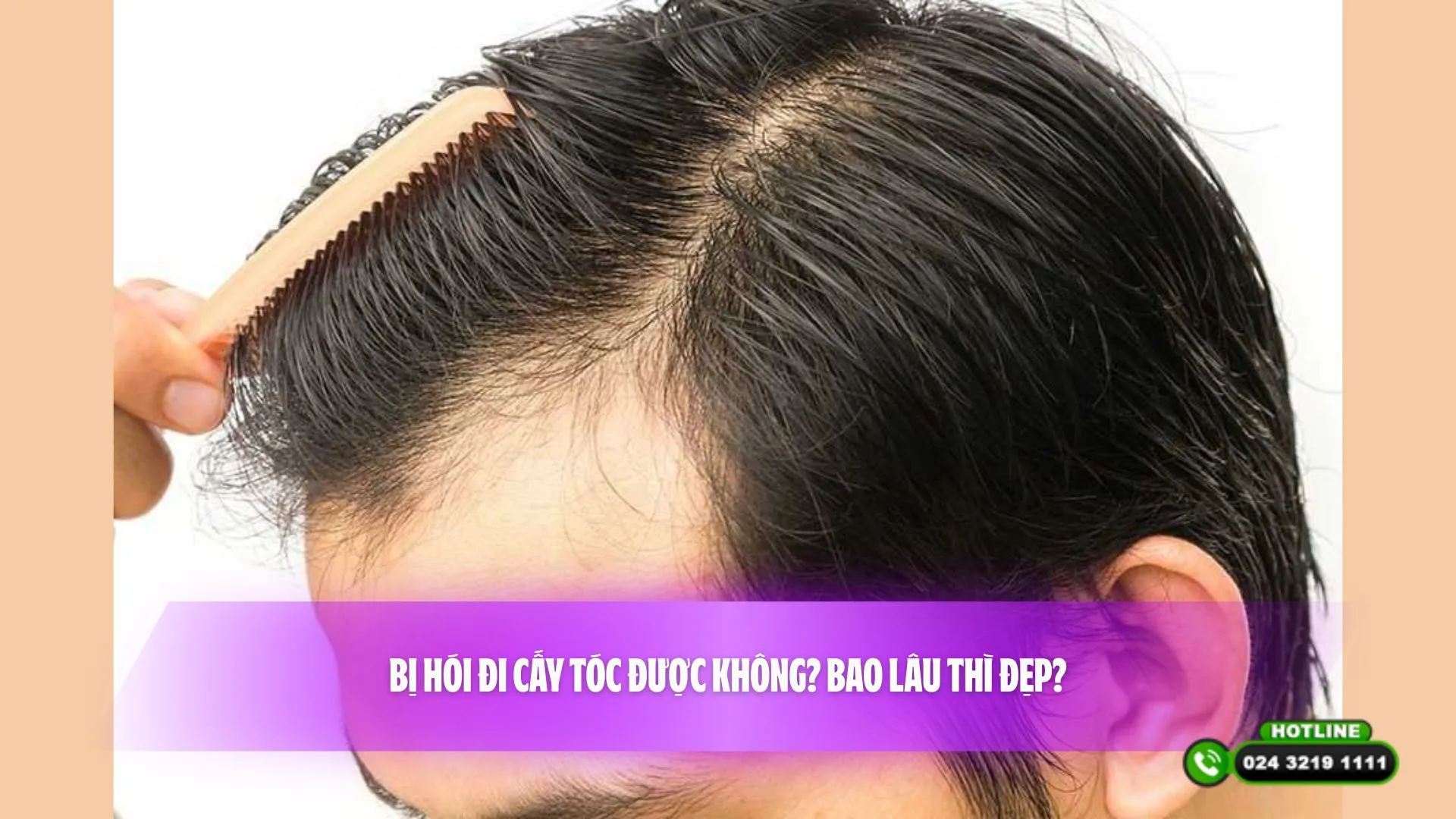 Bị hói đi cấy tóc được không? Bao lâu thì đẹp?