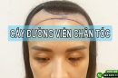 Cấy đường viền chân tóc: Định hình cấu trúc gương mặt, khắc phục dứt điểm trán cao