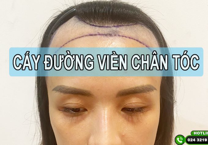 Cấy đường viền chân tóc: Định hình cấu trúc gương mặt, khắc phục dứt điểm trán cao