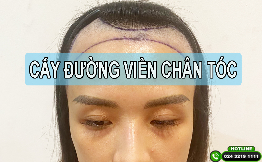Cấy đường viền chân tóc: Định hình cấu trúc gương mặt, khắc phục dứt điểm trán cao