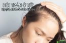 Hói trán ở nữ: Dấu hiệu, nguyên nhân và giải pháp khắc phục hiệu quả