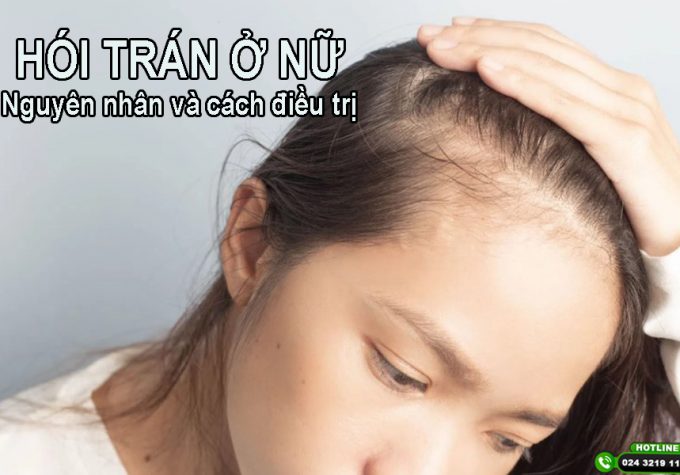 Hói trán ở nữ: Dấu hiệu, nguyên nhân và giải pháp khắc phục hiệu quả