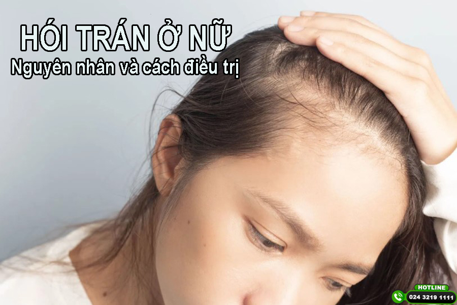 Hói trán ở nữ: Dấu hiệu, nguyên nhân và giải pháp khắc phục hiệu quả