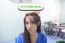 Kỹ thuật cấy tóc không cần cạo PNS: Đẹp ngay sau cấy, không cần đợi tóc mọc dài