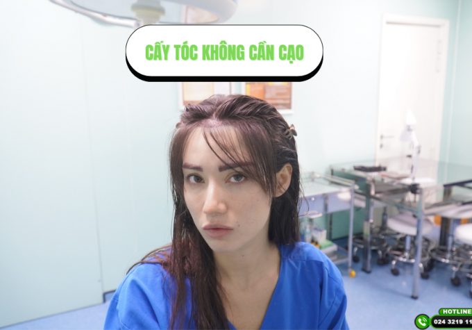Kỹ thuật cấy tóc không cần cạo PNS: Đẹp ngay sau cấy, không cần đợi tóc mọc dài