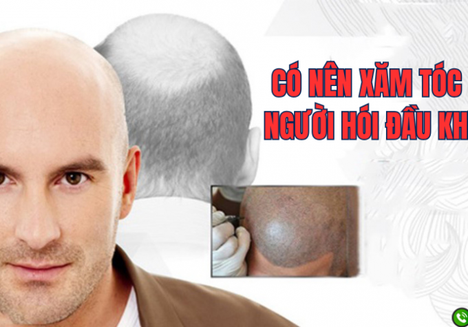 Chuyên gia giải đáp: Có nên xăm tóc cho người hói đầu không?