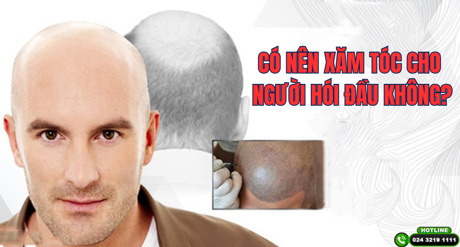 Chuyên gia giải đáp: Có nên xăm tóc cho người hói đầu không?