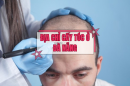 Top 5 địa chỉ cấy tóc ở Đà Nẵng được quan tâm nhiều nhất