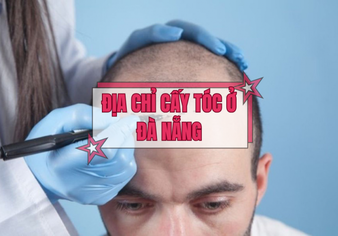 Top 5 địa chỉ cấy tóc ở Đà Nẵng được quan tâm nhiều nhất