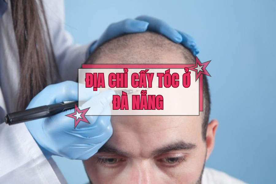 Top 5 địa chỉ cấy tóc ở Đà Nẵng được quan tâm nhiều nhất