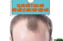 Trị hói đầu ở nam giới: Giải pháp nào mang lại hiệu quả rõ rệt?