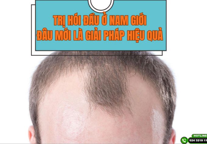 Trị hói đầu ở nam giới: Giải pháp nào mang lại hiệu quả rõ rệt?
