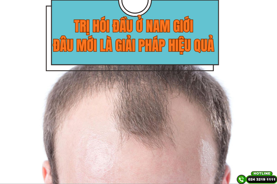 Trị hói đầu ở nam giới: Giải pháp nào mang lại hiệu quả rõ rệt?