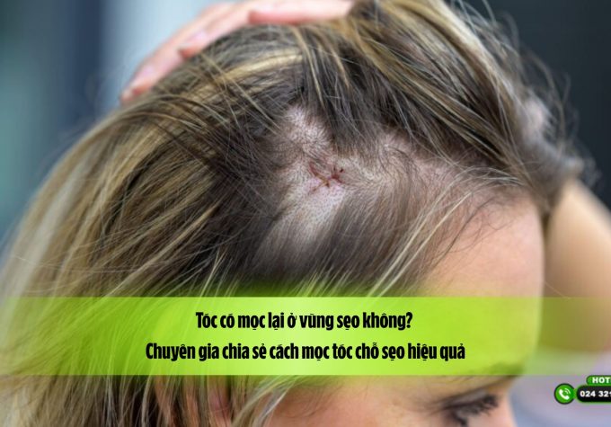 Tóc có mọc lại ở vùng sẹo không? Chuyên gia chia sẻ cách mọc tóc chỗ sẹo hiệu quả