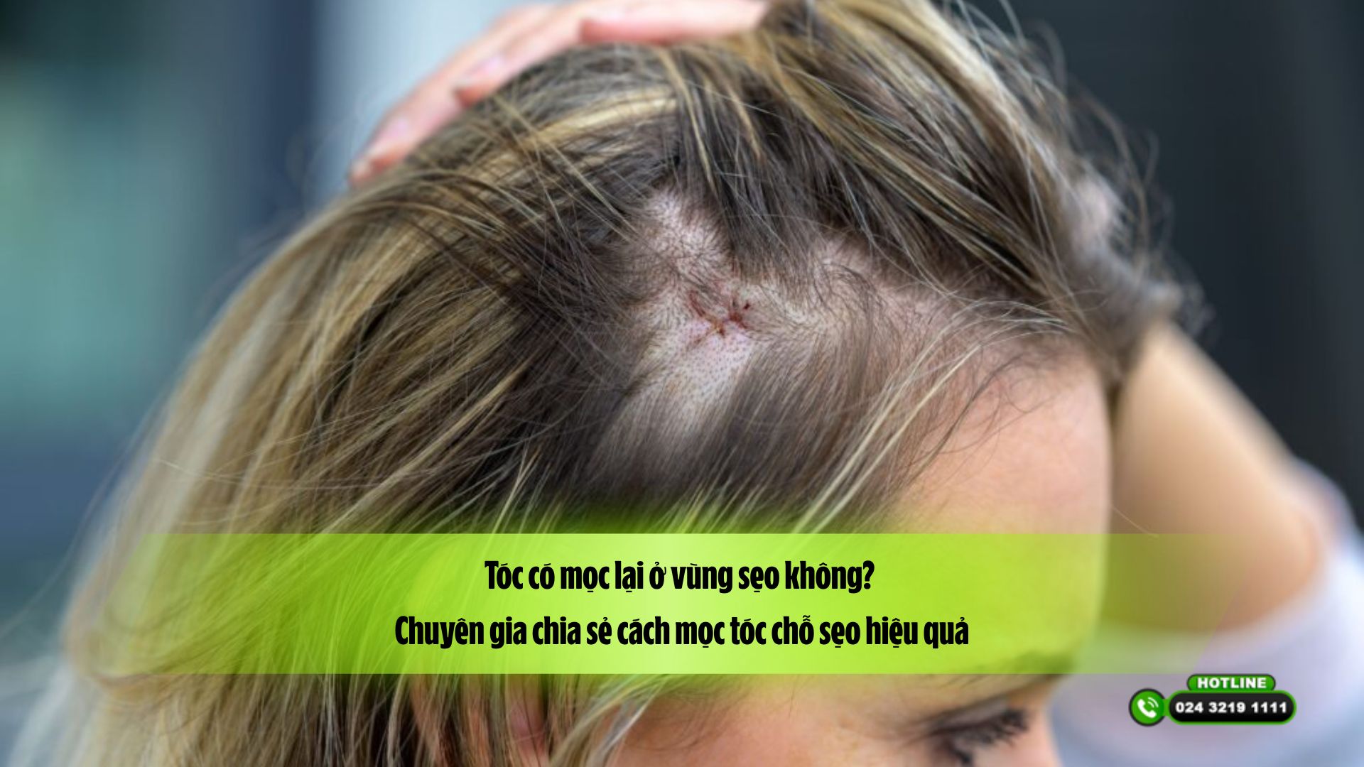 Tóc có mọc lại ở vùng sẹo không? Chuyên gia chia sẻ cách mọc tóc chỗ sẹo hiệu quả