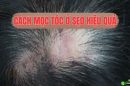 [Bật mí] Cách mọc tóc ở sẹo hiệu quả, nhanh chóng và thẩm mỹ