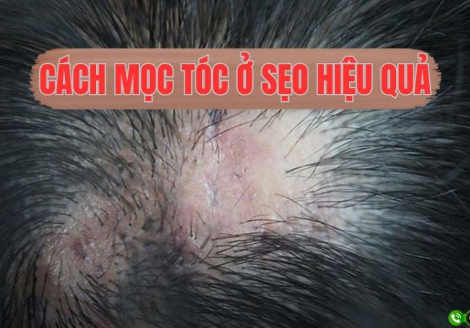 [Bật mí] Cách mọc tóc ở sẹo hiệu quả, nhanh chóng và thẩm mỹ