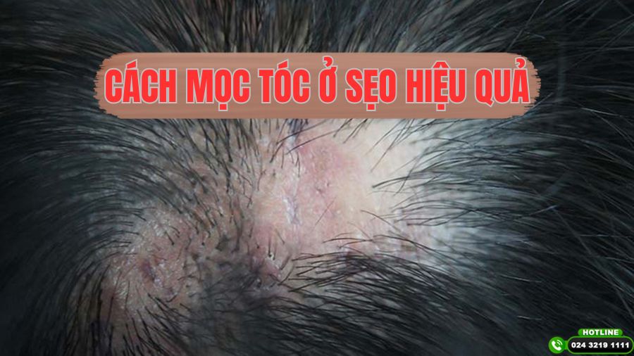 [Bật mí] Cách mọc tóc ở sẹo hiệu quả, nhanh chóng và thẩm mỹ
