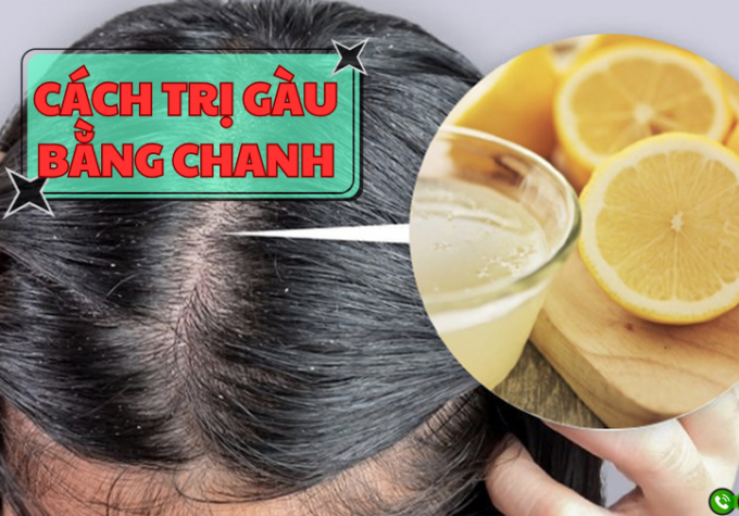 Top 5 cách trị gàu bằng chanh dễ làm tại nhà