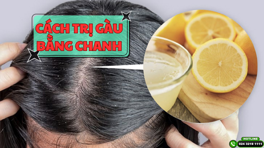 Top 5 cách trị gàu bằng chanh dễ làm tại nhà