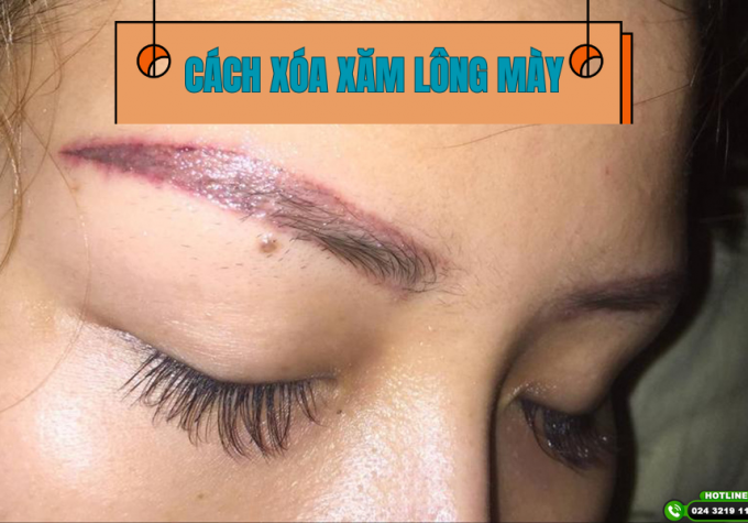 Bật mí cách xóa xăm lông mày tại nhà an toàn, không lo để lại sẹo