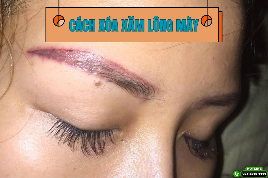 Bật mí cách xóa xăm lông mày tại nhà an toàn, không lo để lại sẹo