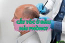 Cấy tóc ở đâu Hải Phòng? Gợi ý địa chỉ uy tín, bác sĩ giỏi và kết quả tự nhiên