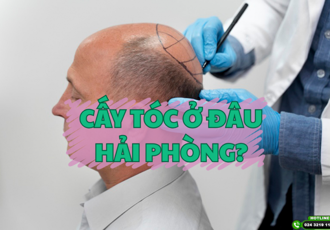 Cấy tóc ở đâu Hải Phòng? Gợi ý địa chỉ uy tín, bác sĩ giỏi và kết quả tự nhiên