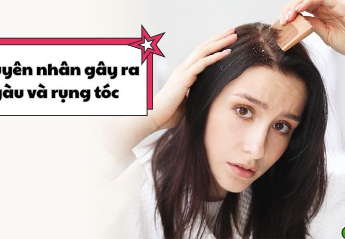 Bóc mẽ nguyên nhân bị gàu và rụng tóc cùng cách điều trị tốt nhất