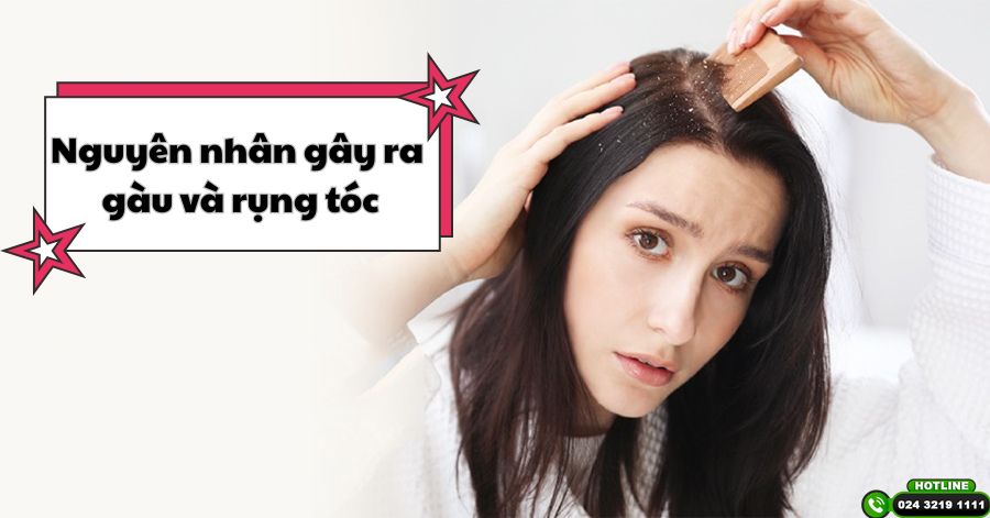 Bóc mẽ nguyên nhân bị gàu và rụng tóc cùng cách điều trị tốt nhất