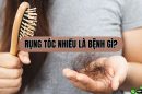 Chuyên gia giải đáp: Rụng tóc nhiều bị bệnh gì?