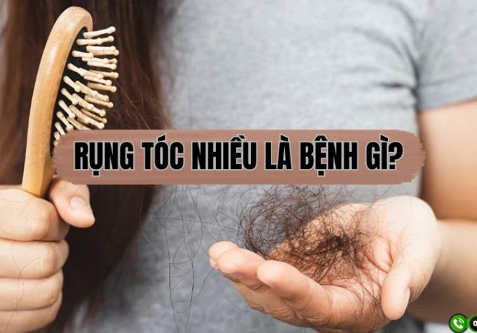 Chuyên gia giải đáp: Rụng tóc nhiều bị bệnh gì?
