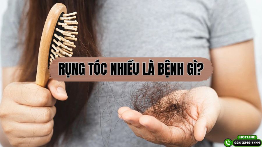 Chuyên gia giải đáp: Rụng tóc nhiều bị bệnh gì?