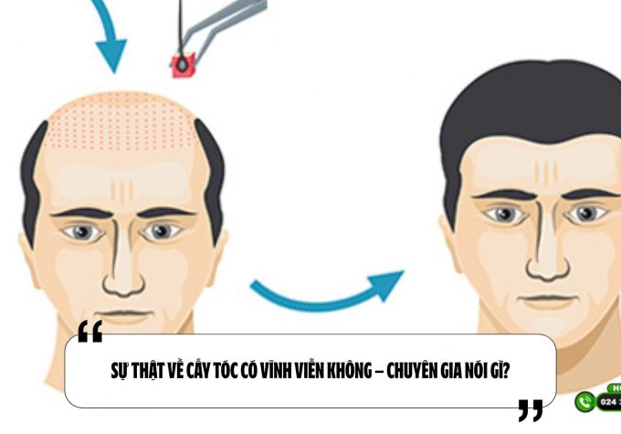 Sự thật về cấy tóc có vĩnh viễn không – Chuyên gia nói gì?