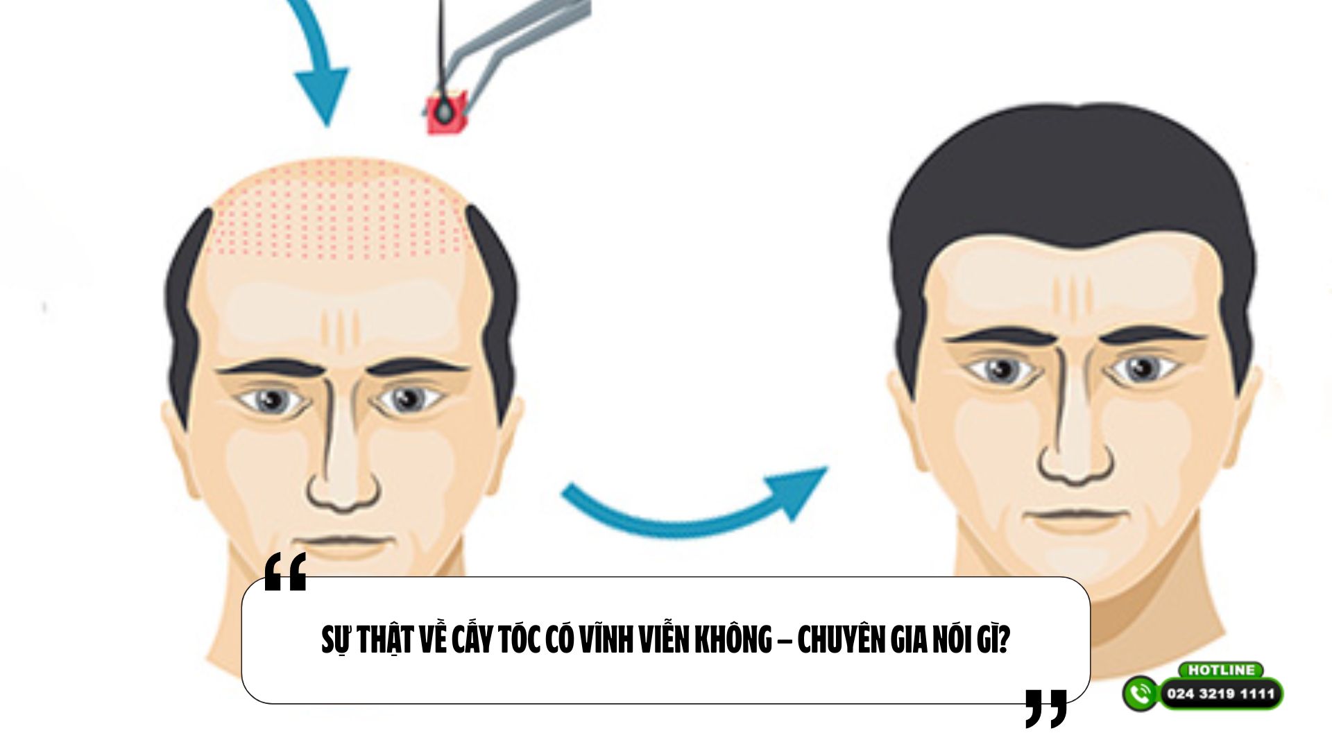 Sự thật về cấy tóc có vĩnh viễn không – Chuyên gia nói gì?