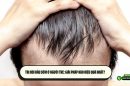 Trị hói đầu sớm ở người trẻ: Giải pháp nào hiệu quả nhất?