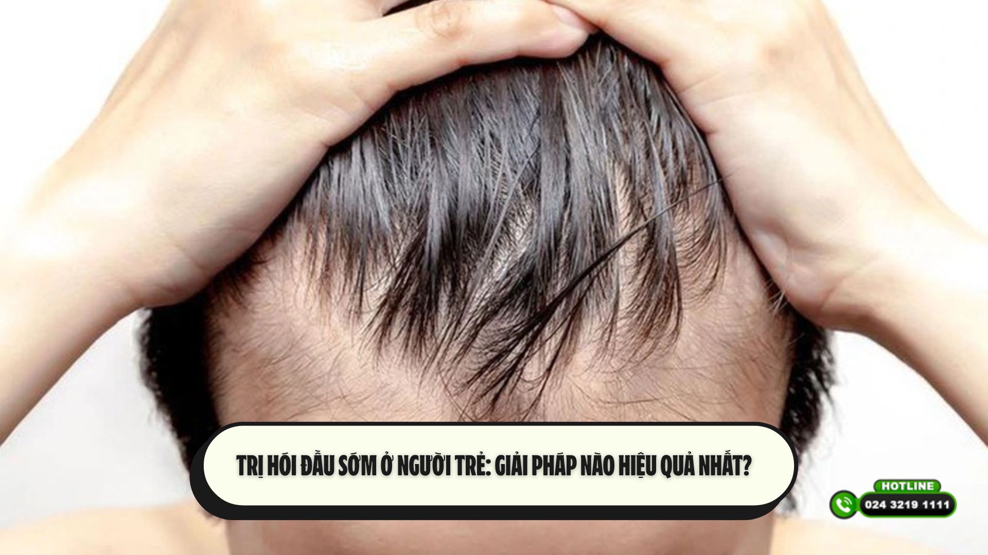 Trị hói đầu sớm ở người trẻ: Giải pháp nào hiệu quả nhất?