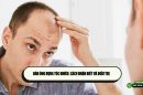 Đàn ông rụng tóc nhiều: cách nhận biết và điều trị 