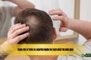 Rụng tóc ở tuổi 30: Nguyên nhân và cách điều trị hiệu quả