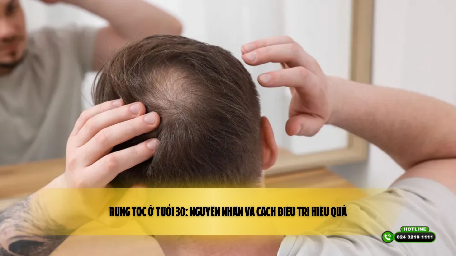 Rụng tóc ở tuổi 30: Nguyên nhân và cách điều trị hiệu quả