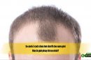 So sánh 3 cách chữa hói chữ M cho nam giới: Đâu là giải pháp tối ưu nhất?