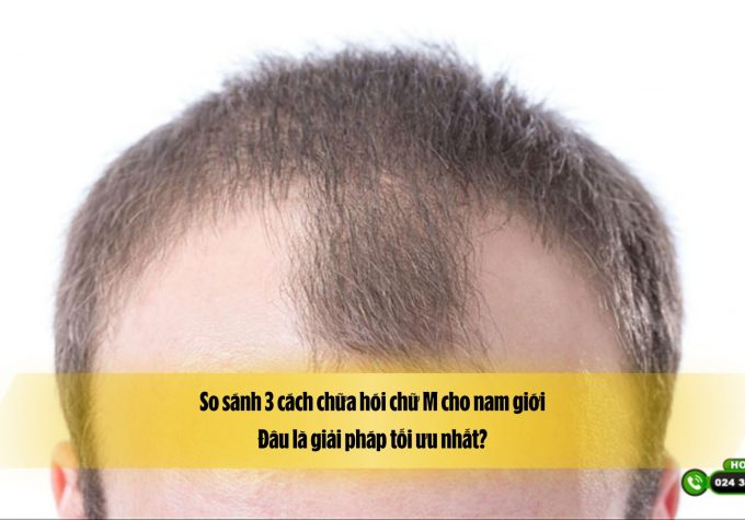 So sánh 3 cách chữa hói chữ M cho nam giới: Đâu là giải pháp tối ưu nhất?
