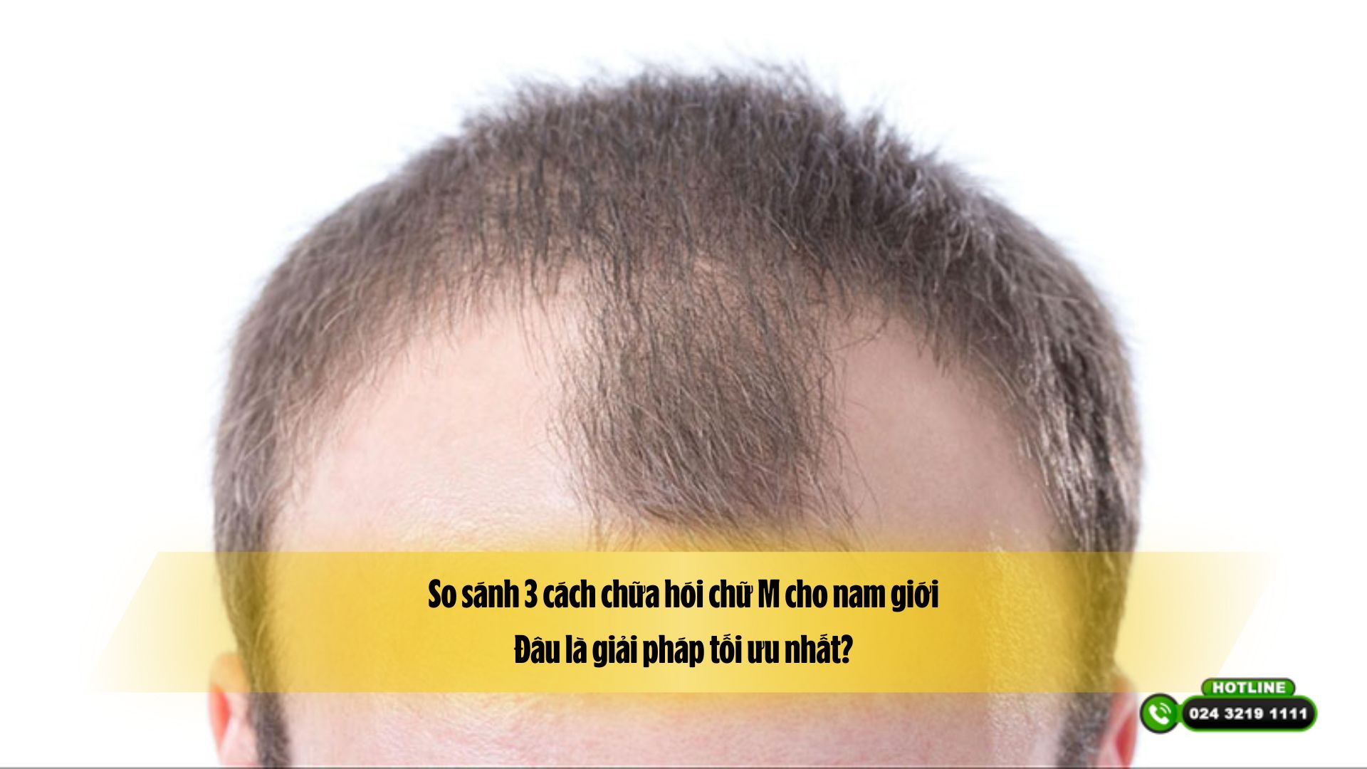 So sánh 3 cách chữa hói chữ M cho nam giới: Đâu là giải pháp tối ưu nhất?