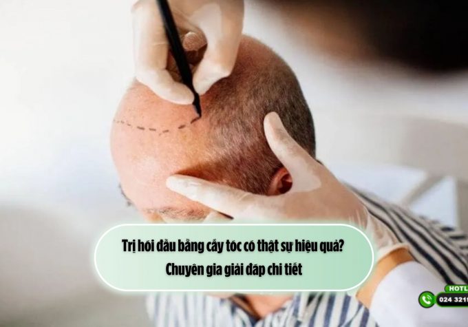 Trị hói đầu bằng cấy tóc có thật sự hiệu quả? Chuyên gia giải đáp chi tiết