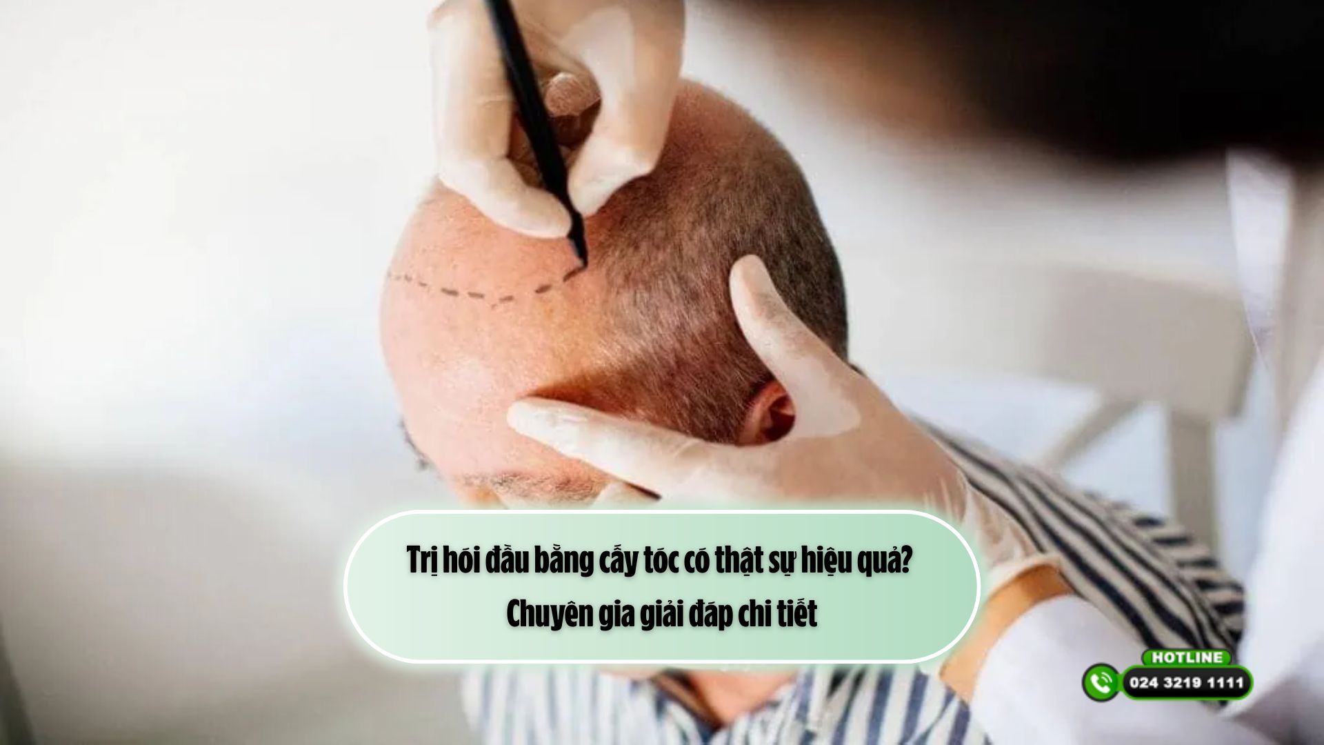 Trị hói đầu bằng cấy tóc có thật sự hiệu quả? Chuyên gia giải đáp chi tiết