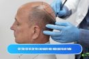 Tất tần tật về cấy tóc cho người hói: Hiệu quả và an toàn