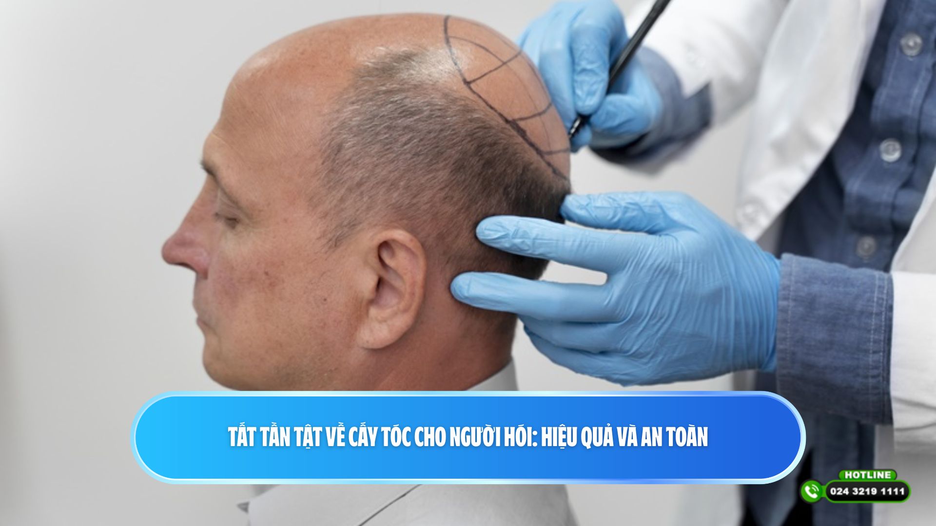 Tất tần tật về cấy tóc cho người hói: Hiệu quả và an toàn