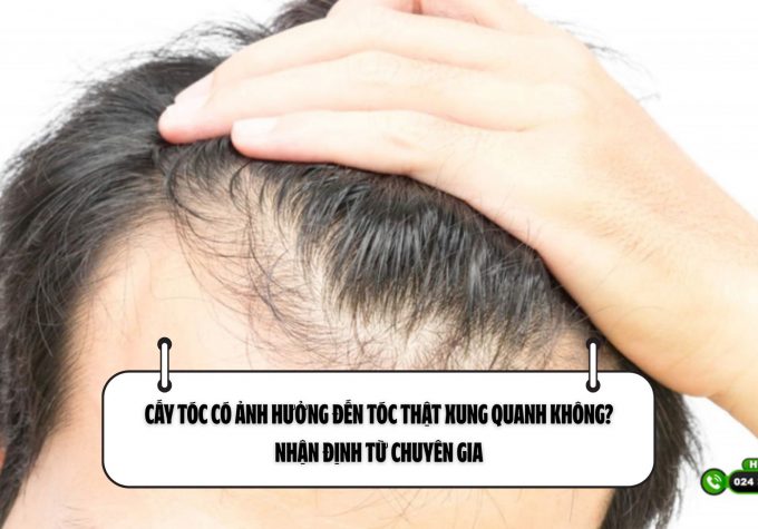 Cấy tóc có ảnh hưởng đến tóc thật xung quanh không? Nhận định từ chuyên gia